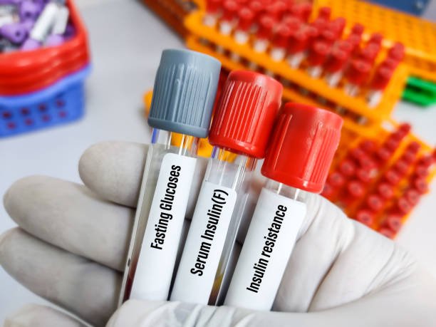  Fasting Insulin: The Missing Metabolic Link