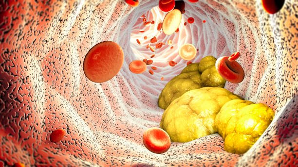 Causes of High Cholesterol - stubborn cholesterol