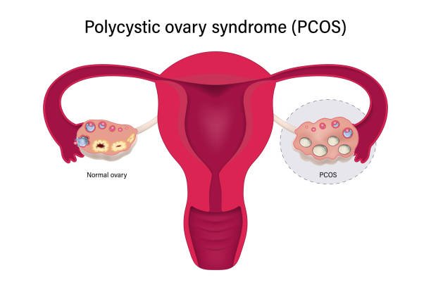 Insulin Resistance and PCOS