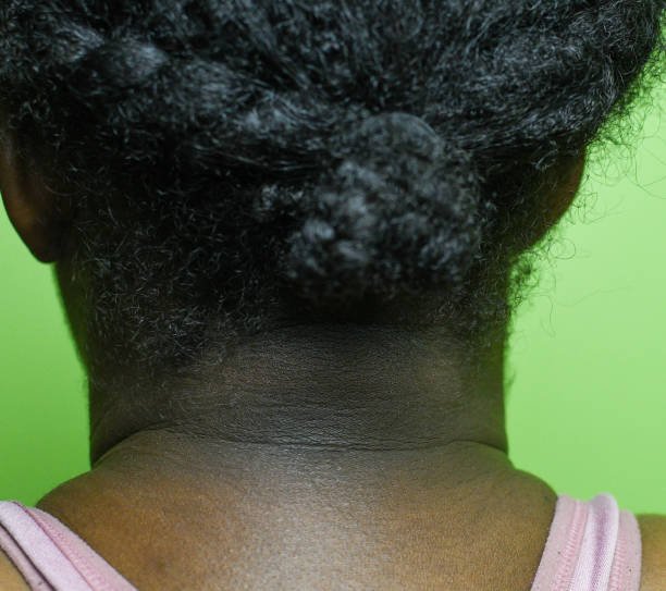 Is Your Neck Black? Understanding Acanthosis Nigricans