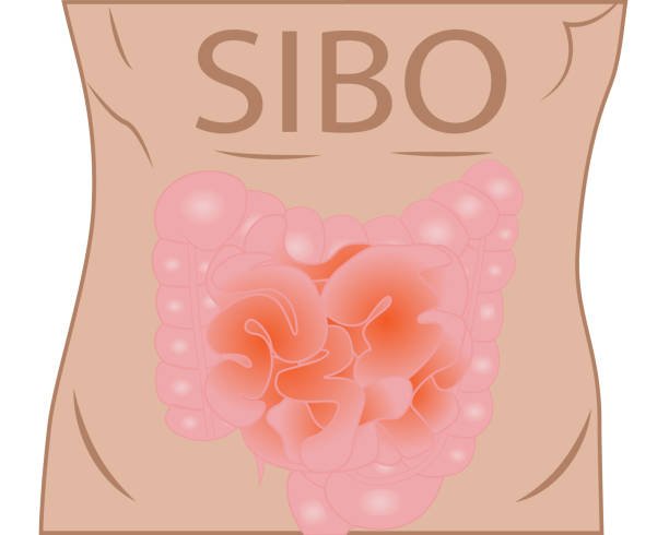 SIBO ( small Intestinal Bacterial Overgrowth)