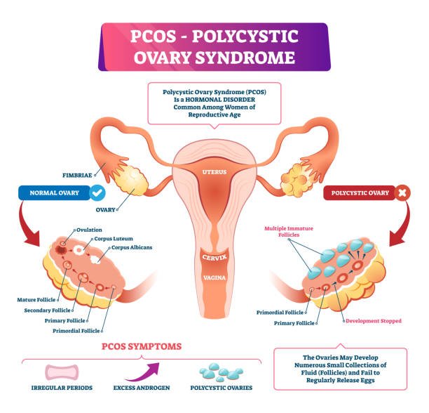 What is PCOS