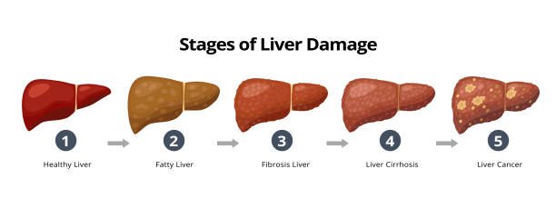 Stages of fatty liver
