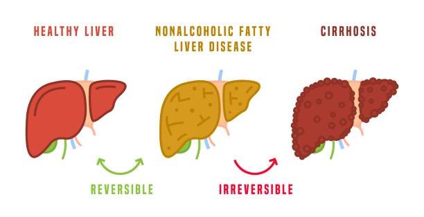 fatty liver