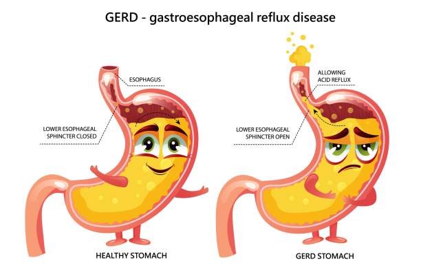 GERD - Acid Reflux