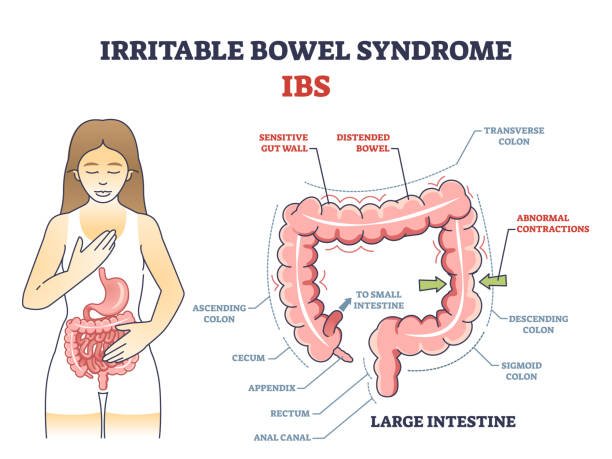 Irritable Bowel Syndrome (IBS)