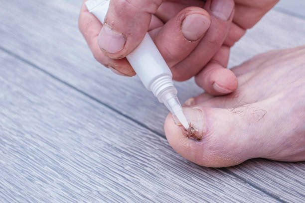 fungal infections like athlete’s foot or nail fungus