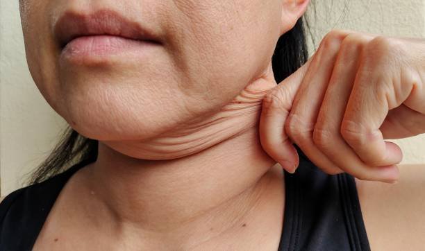 tissue thinning or sagging due to fat loss