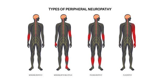 Types of peripheral Neuropathy.