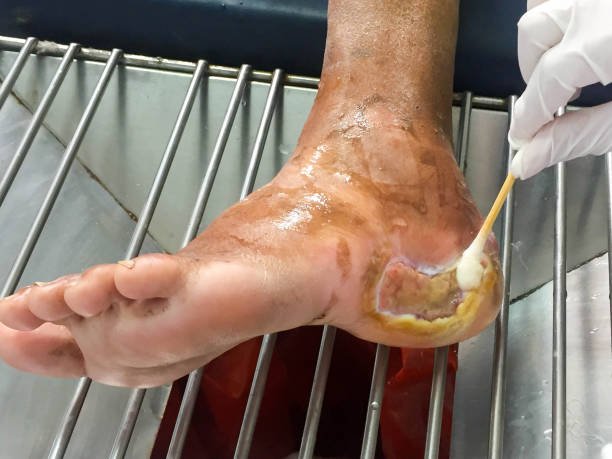 Diabetes foot ulcer