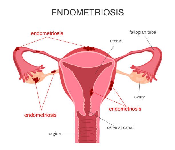 endometriosis medical illustration